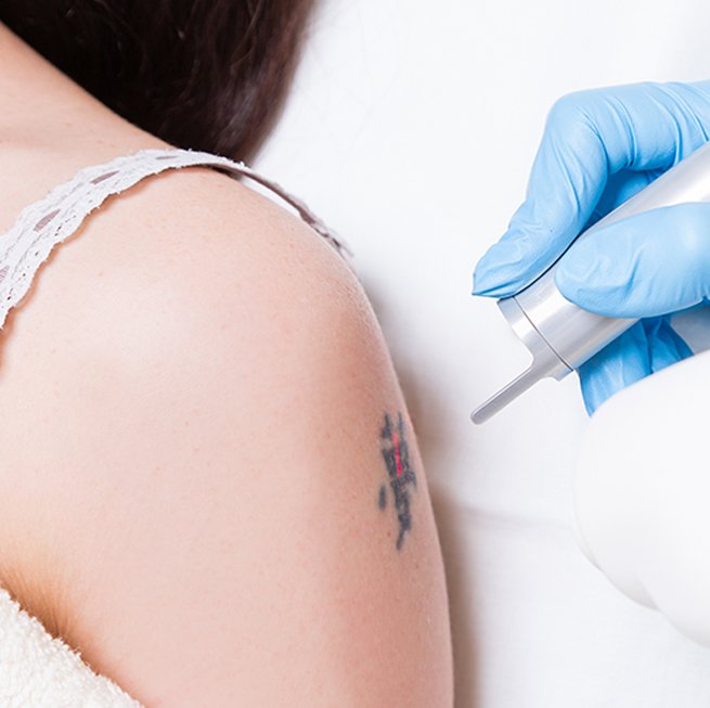 Tattoo removal treatment-